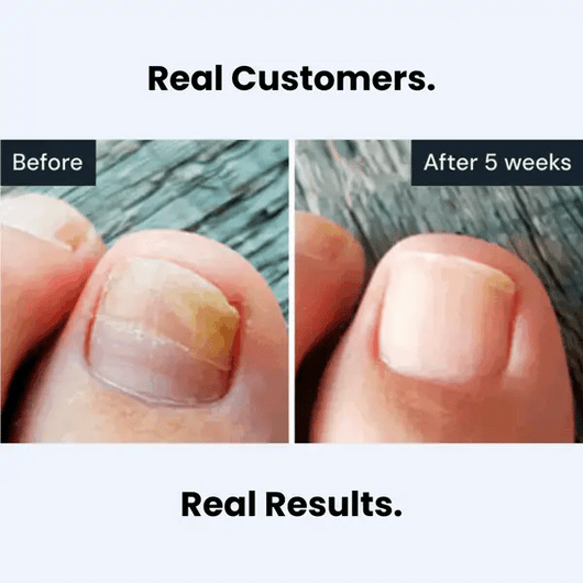 Aventa™ Antifungal Pen